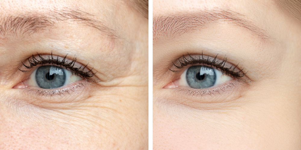 laser-eye-wrinkle-reductio-blog